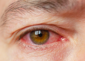 Treatment for eye infections and allergies