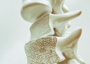 Osteoporosis treatment