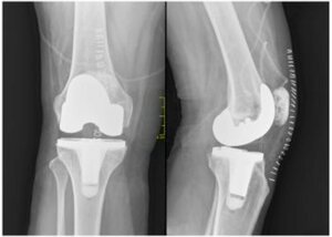 Total knee replacement