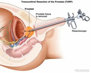 TURP for prostate