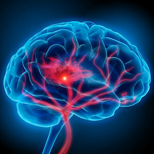 Neurovascular surgery