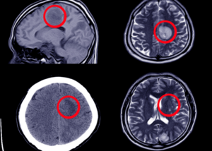 Hydrocephalus Treatment