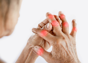 Arthritis treatment