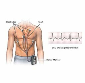 Holter Monitoring