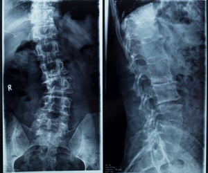 Scoliosis Treatment