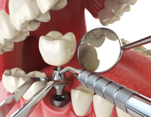 dental implant