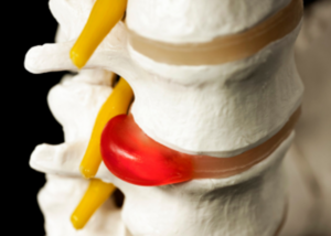 Spinal Herniated Disc Surgery