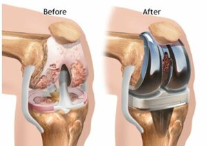 Total knee replacement