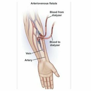 Dialysis AV Fistula Salvage