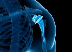 Shoulder Replacement