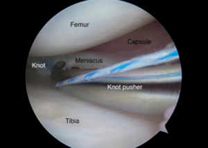 Meniscal Repair