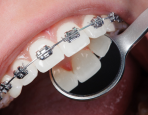 Orthodontic treatment