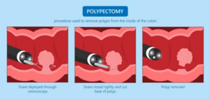 Polypectomy