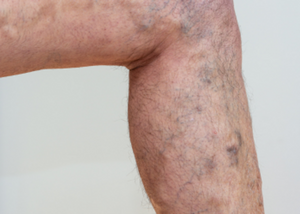 Peripheral Artery Disease