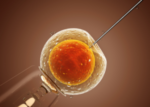IUI (Intrauterine Insemination)