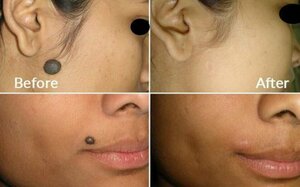Cyst, Mole, Wart Removal