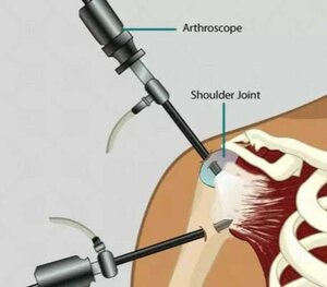 Arthroscopic Shoulder Surgery