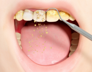 Periodontal Therapy