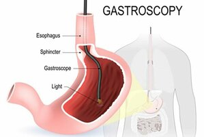 Gastroscopy