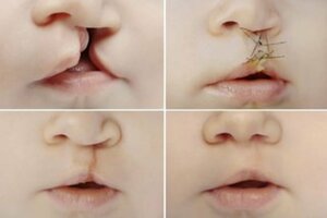 Clelt Lip / Palate Surgery