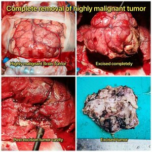 Brain Tumor Surgical Excision | Dr Anand katkar