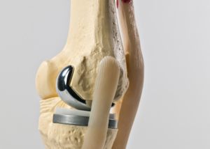 Partial knee replacement