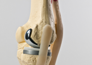 Partial knee replacement