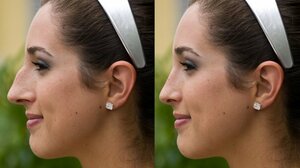 Nose Reshaping