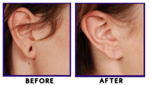 Ear Lobule Repair