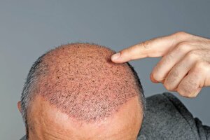 Hair transplant