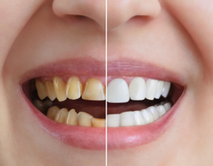 Smile Designing with Aesthetic Dentistry: An Oral Surgeon&rsquo;s Approach|Dr. Vishal Tapadiya