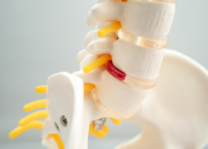 Degenerative Spinal Conditions