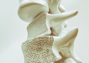 Osteoporosis Management
