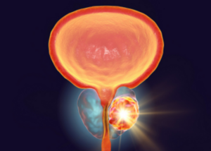 Prostate Diseases