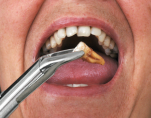 Wisdom Tooth Extraction