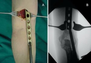 Minimally Invasive Orthopedic Surgery