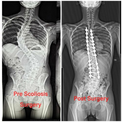 Dr. Ajay Kothari - Spine Surgeon|Shivaji Nagar,Pune