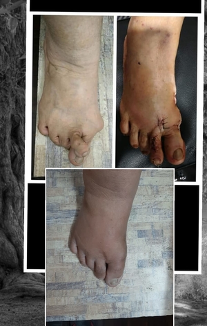 Bunions case solved by Dr. Girish Motwani