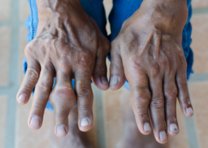 Treatment for Hyperuricemia & Gout | Dr. Maheiish Rokade