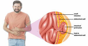 Signs to look if you have Hernia!