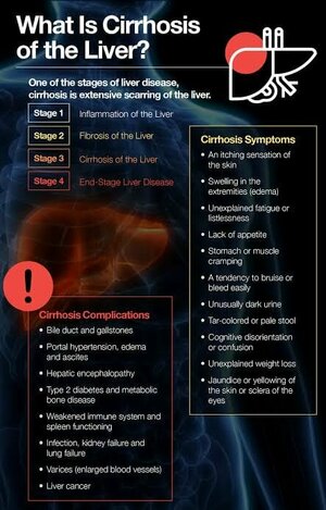Liver Cyrhosis