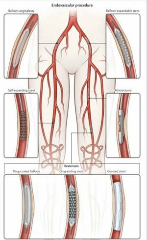 Peripheral Angioplasty