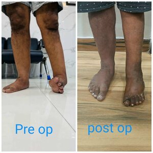 Post CPN Nerve Palsy Treatment in Nagpur | Dr. Girish Motwani