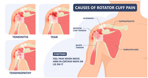 Cause of Rotator Cuff Tendinitis