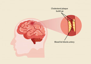 What is Stroke - An Introduction | Dr. Bhushan Joshi