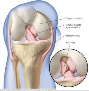 ACL tear is a career-ending SportsInjury