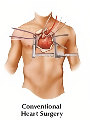Conventional Heart Surgery - Dr. Kishor Deore