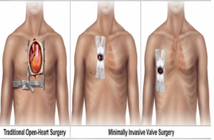 Traditional Open-Heart Surgery and Minimally Invasive Valve Surgery