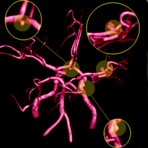 Peripheral aneurysm treatment in Prayagraj