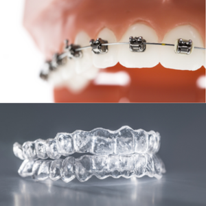 Thumbnail of topic : Orthodontic Treatment in Nal Stop | Dixit Dental Clinic